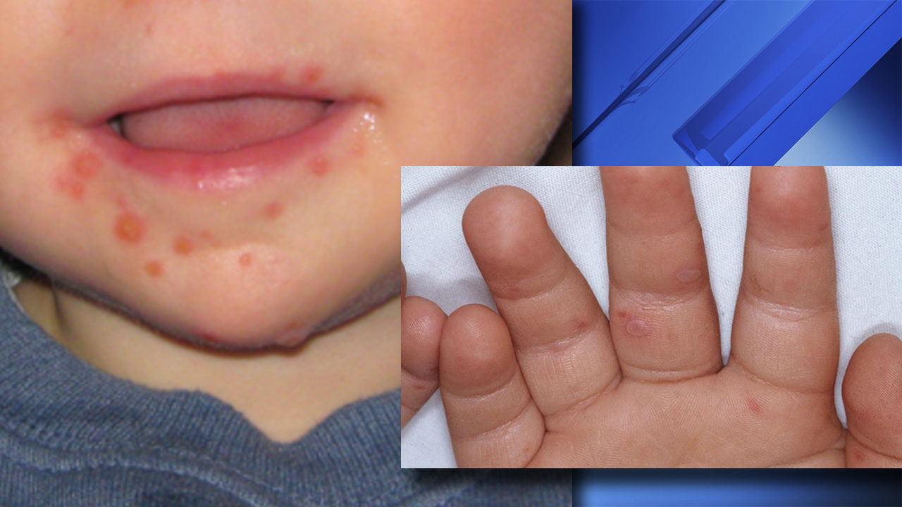 And of mouth pictures hand foot And of mouth pictures hand foot